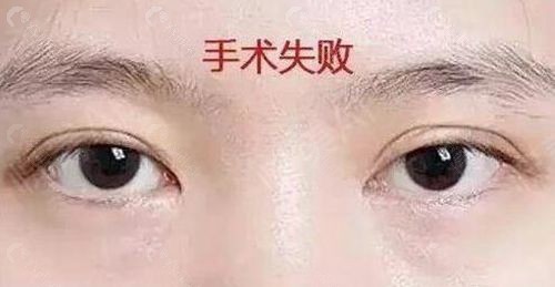 双眼皮手术失败找杜园园修复怎么样