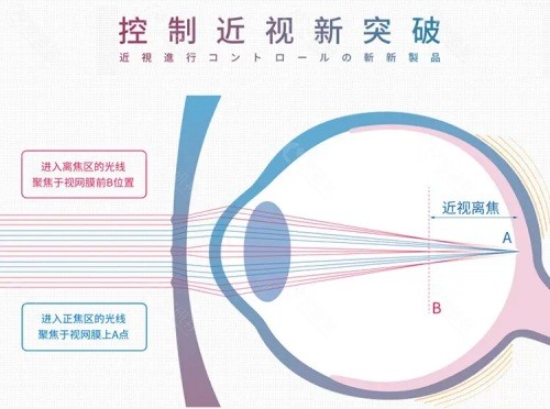 近视防控功能性镜片有哪些