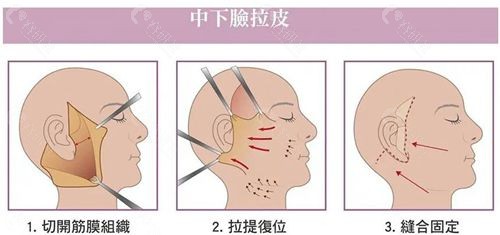 中下面部拉皮除皱手术