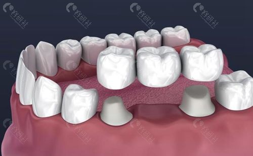 后牙都没了怎么做固定义齿