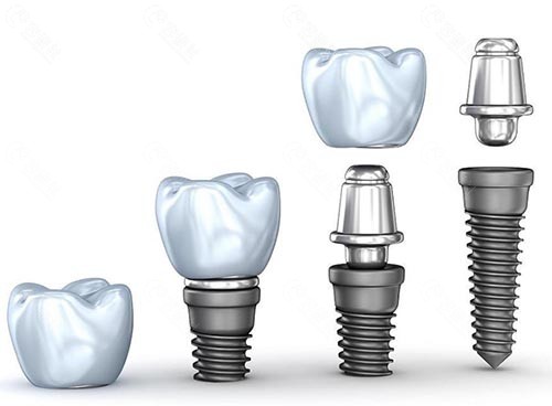 种植体牙冠基台图片