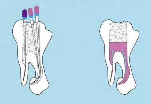 根管治疗后的牙齿又疼了怎么办