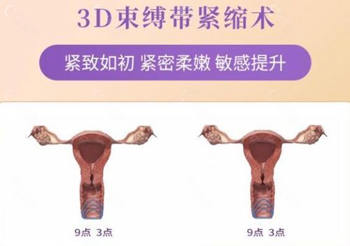 求美者做完3d生物束带后的变化