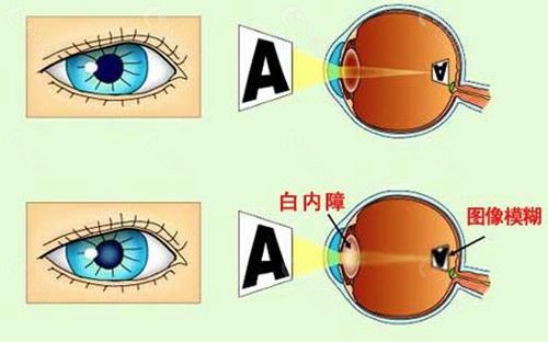 老人70岁以上是不是做白内障手术免费