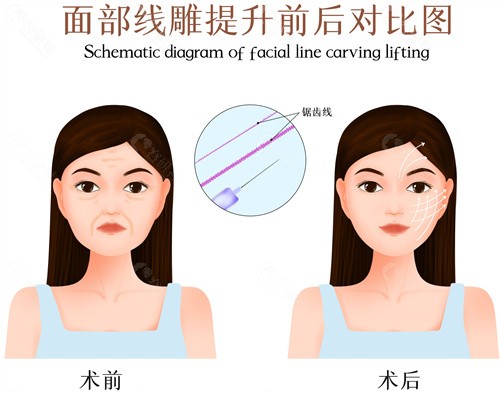 国产面部提升线紧恋和恒生哪个好