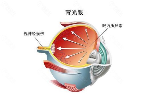 如果患上青光眼应该怎么治疗？