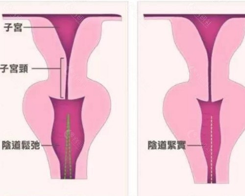 3d束带紧缩术图片