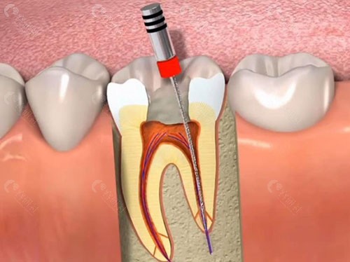 根管治疗模拟图片