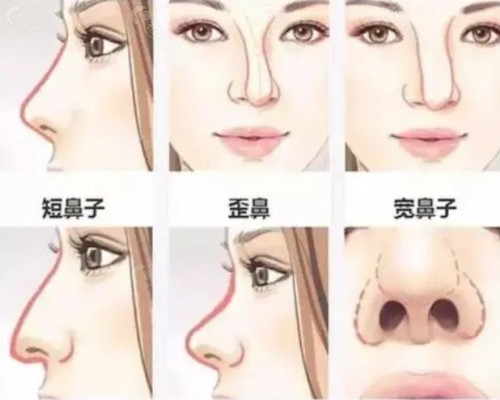 各种鼻型图片