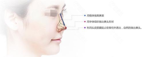 韩国必当归医院隆鼻手术