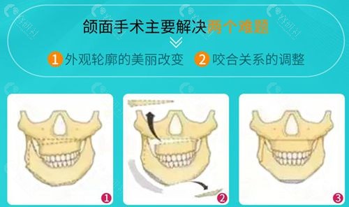 广大医院何锦泉医生正颌怎么样