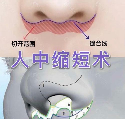 上海清沁医疗美容韩东亮医生做人中缩短手术好不好