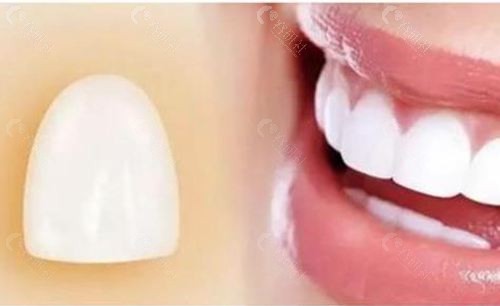 树脂牙齿贴面和瓷贴面的区别是什么