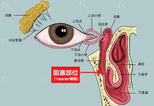 泪囊瘘是小手术吗？需要住院吗？手术多少钱？