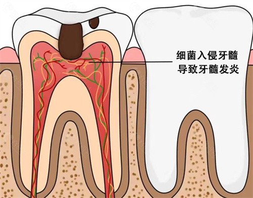 牙烂到什么程度要根管治疗，需要多少钱？