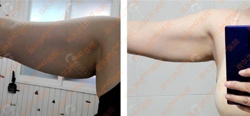 韩国365mc医院手臂Lams吸脂术前和术后对比图