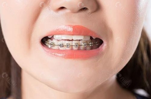 2023儿童牙齿矫正收费标准