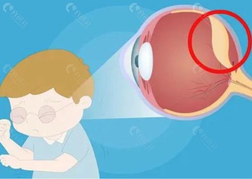 视网膜脱落是什么原因引起的