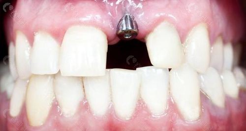 一个种植牙可以带两颗牙吗