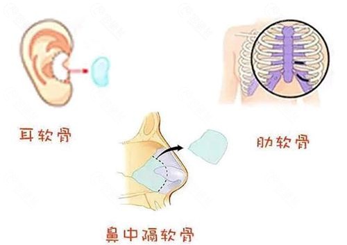 肋骨鼻和耳软骨鼻哪个吸收的更多