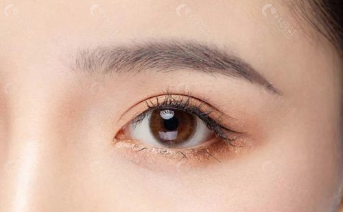 石家庄俏佳人翟彦刚修复双眼皮实例分享