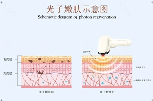 光子嫩肤能去痘坑吗