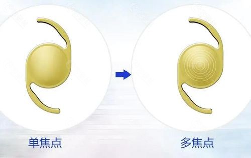 多焦点人工晶体为什么有些人不能装