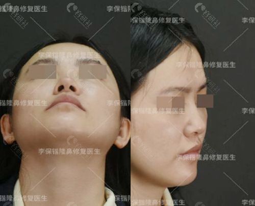 隆鼻修复医生李保锴肋软骨鼻综合手术前图片