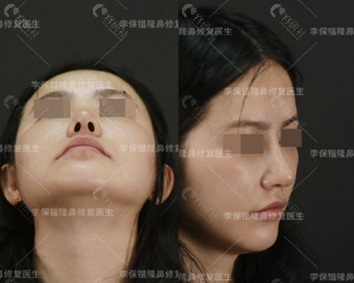 隆鼻修复医生李保锴肋软骨鼻综合手术后四个月图片