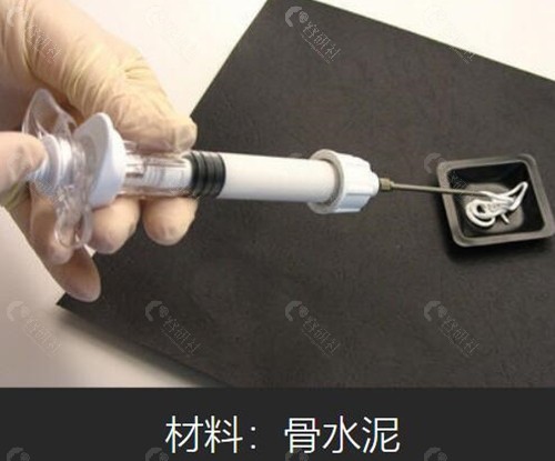 头皮塞骨水泥垫高颅顶靠谱吗？