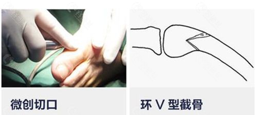 北京圣嘉新大脚骨手术方法