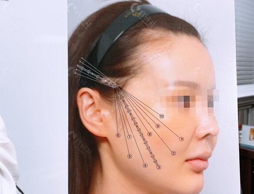 韩国profile普罗菲耳整形外科拉皮优势介绍
