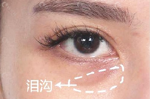 北京填充泪沟哪家比较好？