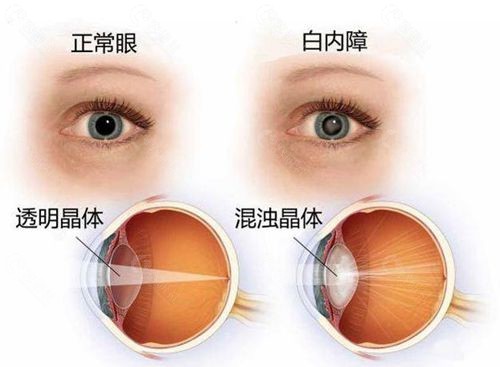 正常眼和白内障的区别