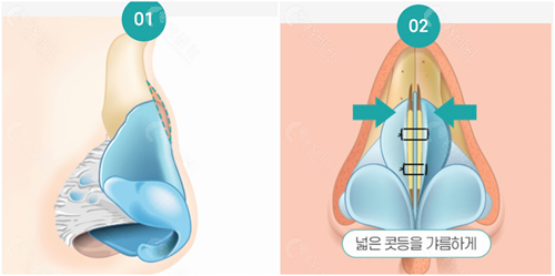 韩国温度整形外科隆鼻方法