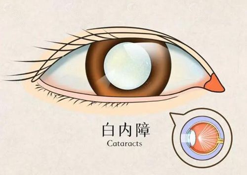 爱尔眼科白内障免费治疗政策是什么