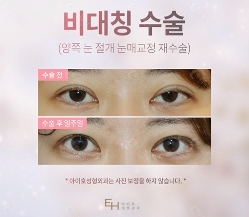 韩国EH眼修复医院双眼皮过宽修复前后对比图