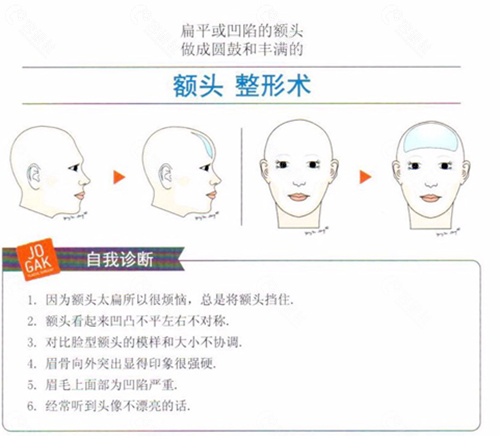 雕刻整形外科额头填充骨水泥手术