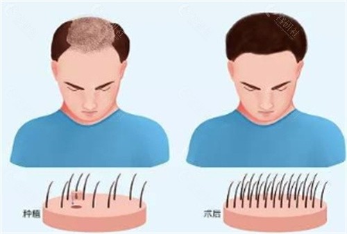 植发后取发区多久能恢复正常