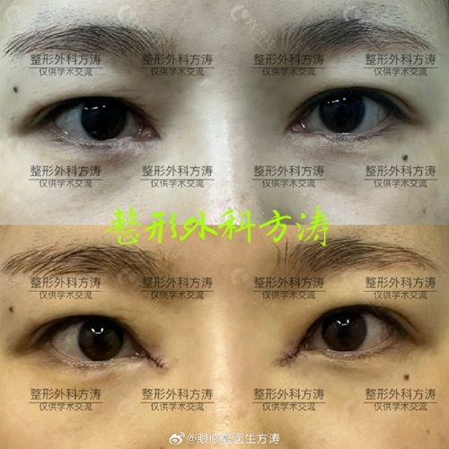 武汉方涛包眼角修复手术前后图片