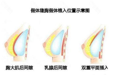 双平面隆胸示意图