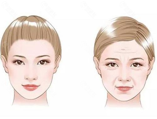 拉皮手术可以改善皮肤状态，减少皱纹