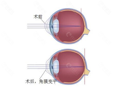 近视手术前后对比