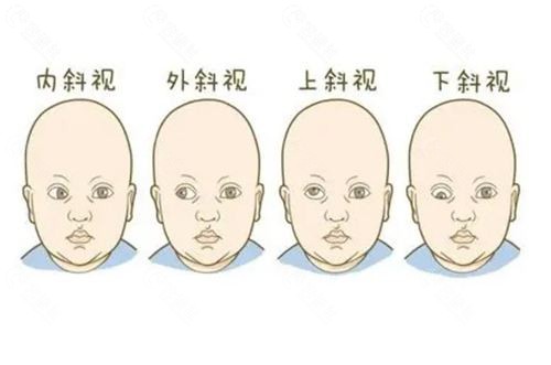 爱尔眼科斜视矫正价格