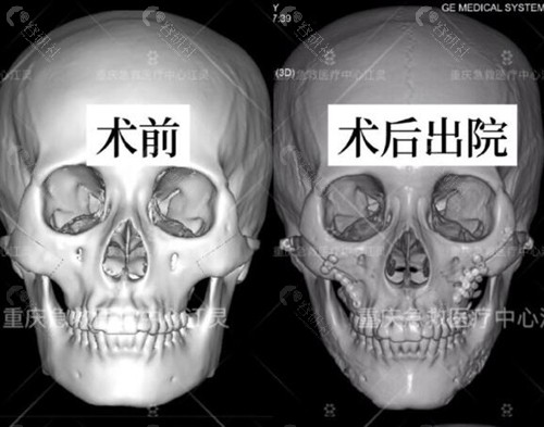 重庆江灵医生磨骨价格表