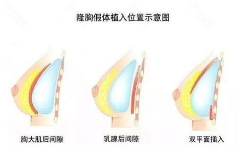 隆胸手术假体植入层次