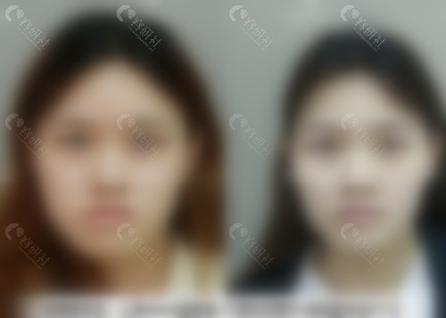 广州广大何锦泉正颌手术前后对比图