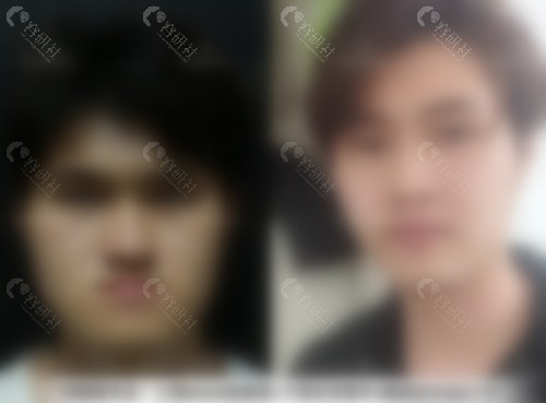 成人地包天矫正后脸型变化图