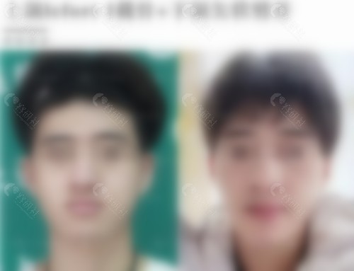 成人地包天矫正前后对比
