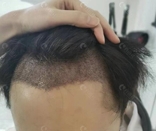 贵港贞韩植发优势介绍